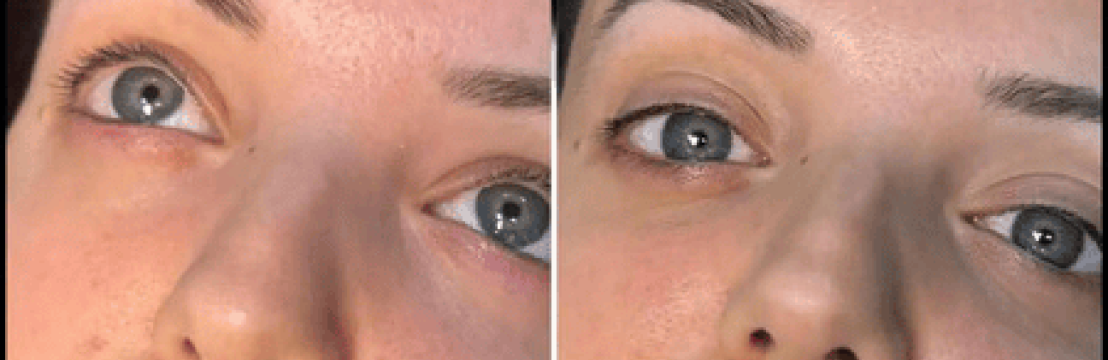 Dermal Fillers